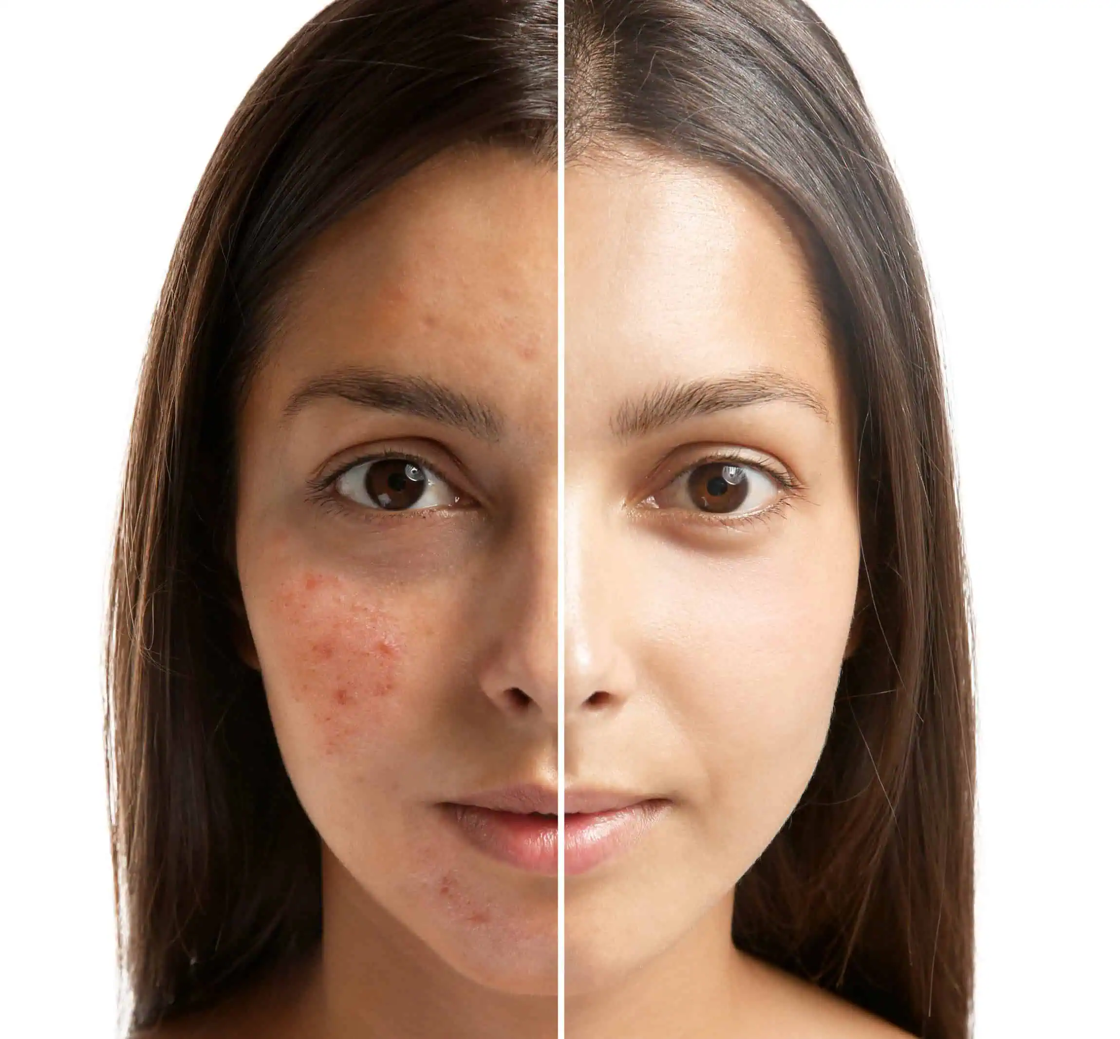 Acne Removal Blog