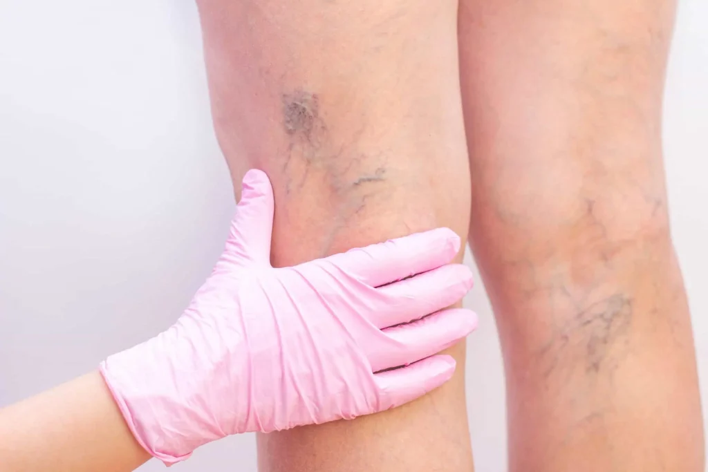 Gmax Laser for vein Removal