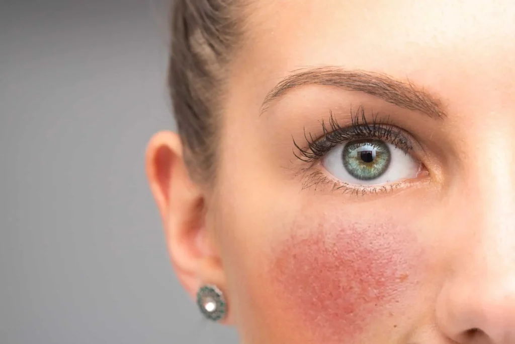 Rosacea Red Spots and unwanted veins