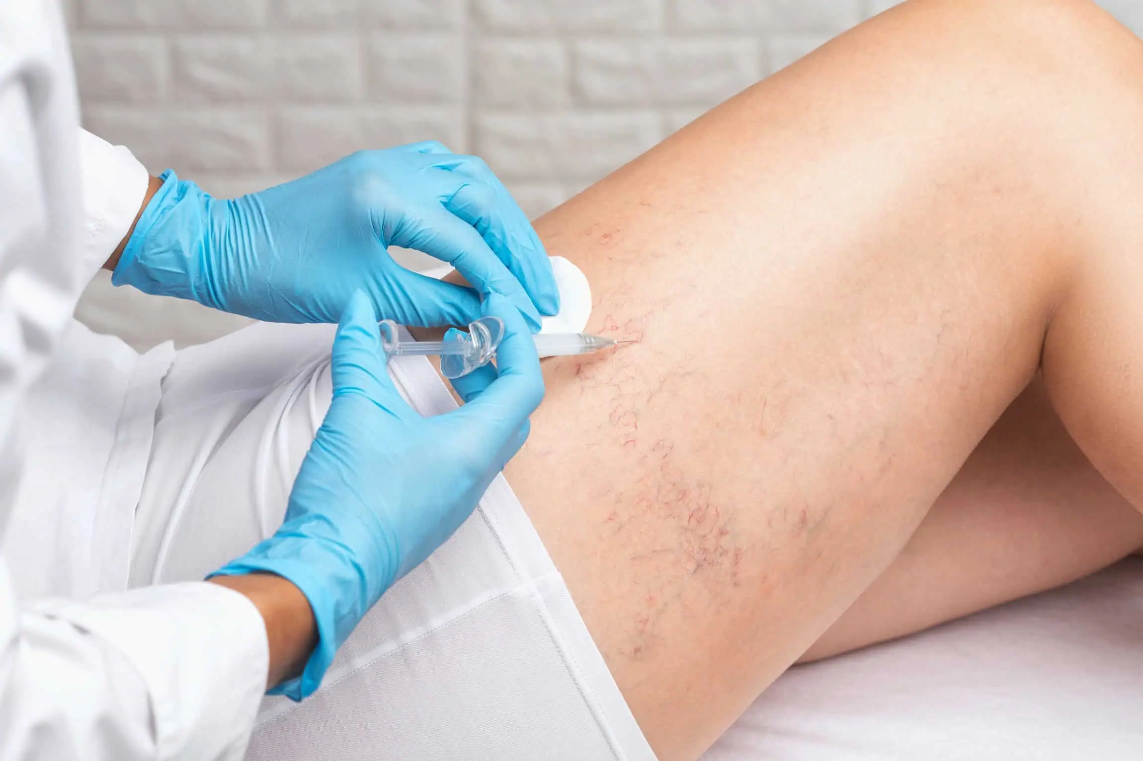 Varicose vein by premier derm center in houston