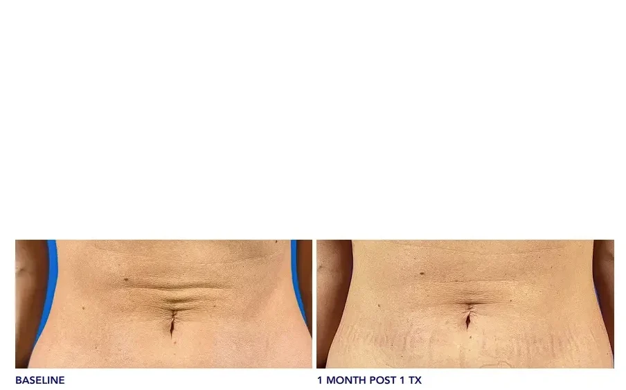 Images Courtesy of Lisa Pruett, MD, FAAD